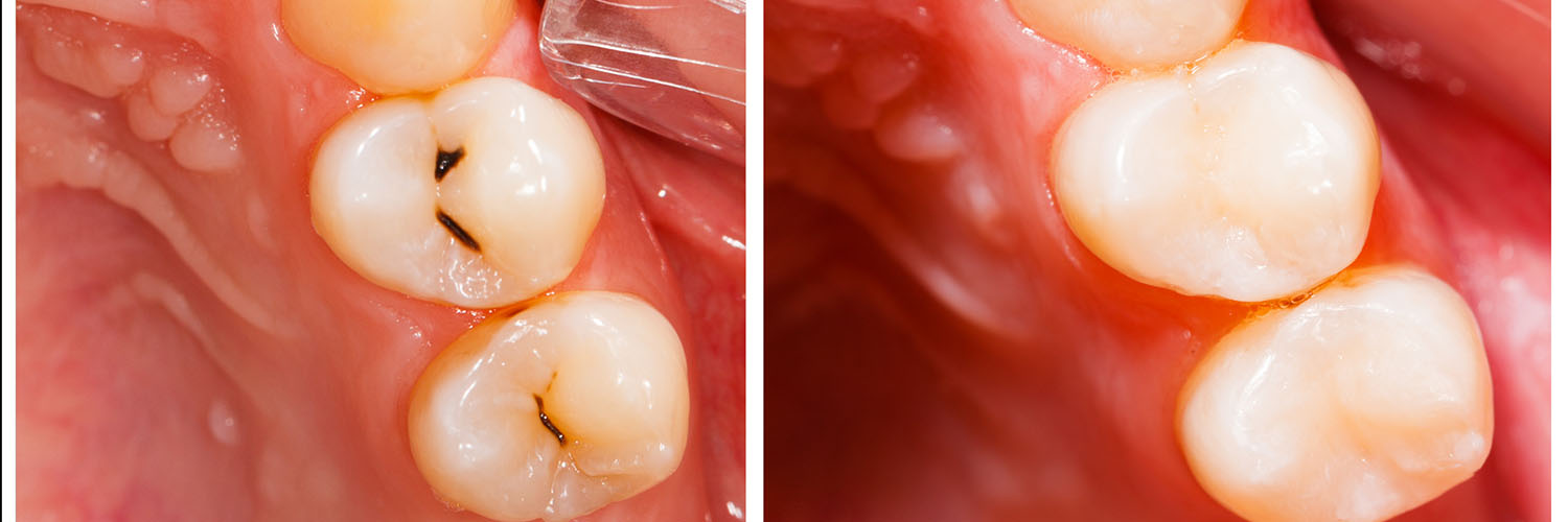 The image shows a close-up view of a person s teeth with visible decay and cavities, emphasizing dental health issues.