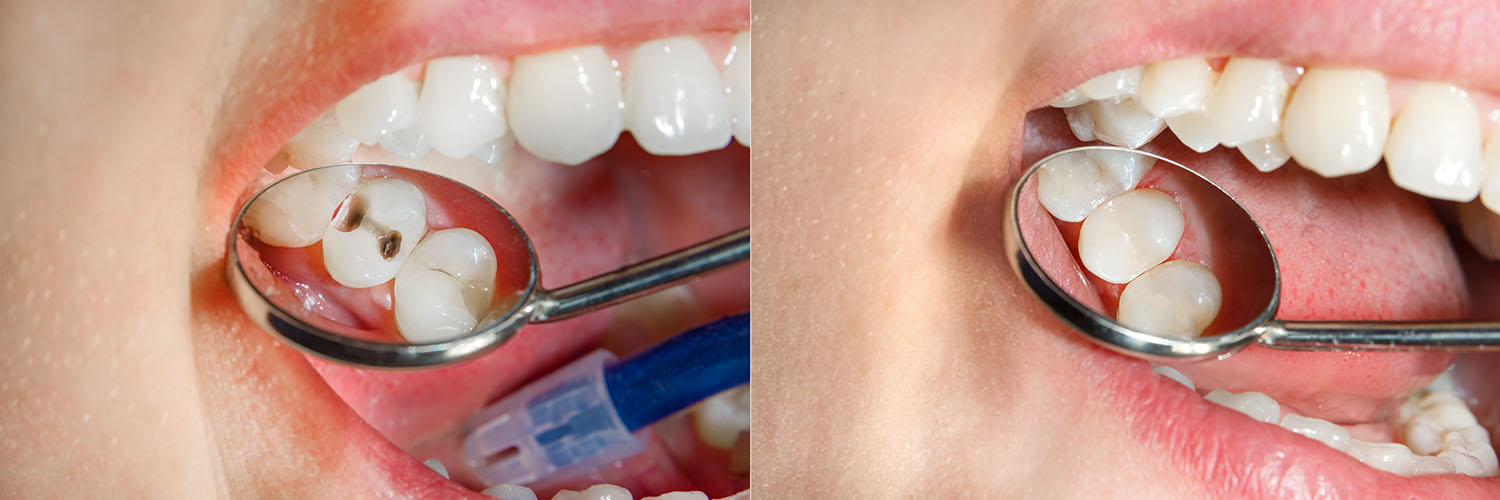 The image shows a person s mouth with an open toothbrush over their teeth and a magnifying glass on their tongue, with two photos of this scene side by side.